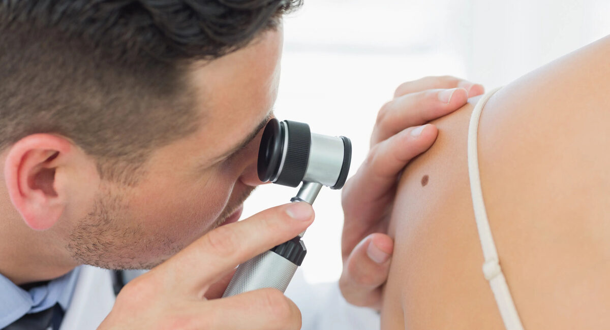 melanoma, crecimiento de casos, incidencia interanual, redecan, SEOM, cáncer de piel, exposición solar, lunares