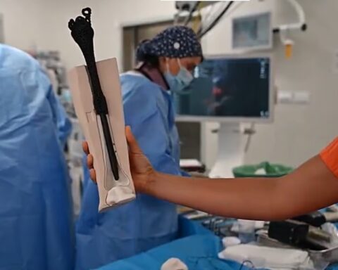 La próitesis ósea personalizada y el equipo que la implantado.